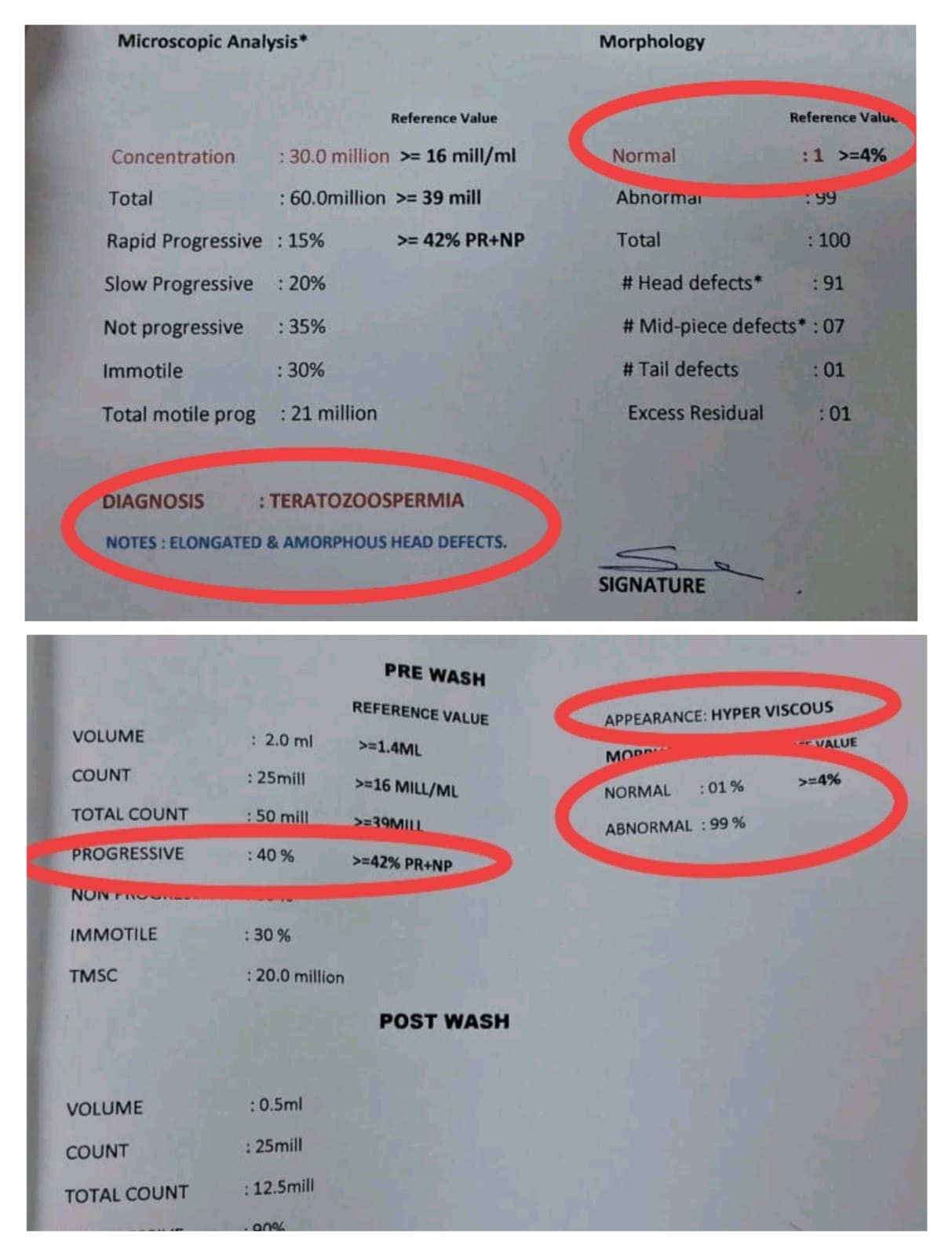 Vikram's semen analysis report showing teratozoospermia with only 1% normal morphology and hyper viscous appearance